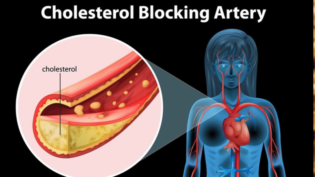 The Link Between High Cholesterol And Clogged Arteries