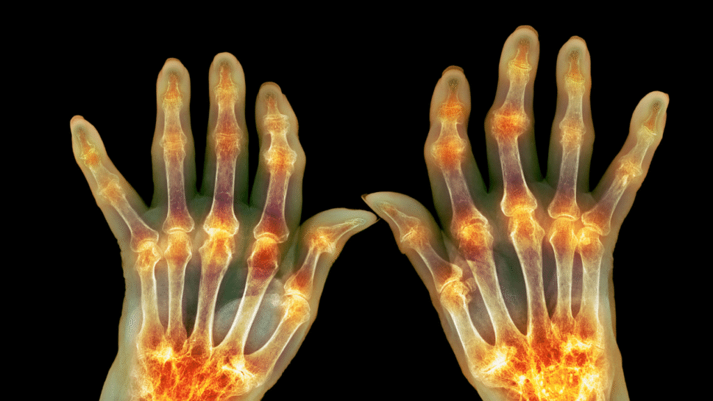 Stages of Rheumatoid Arthritis: From Mild to Severe