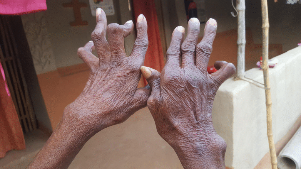 What Is Rheumatoid Arthritis? Causes, Symptoms and Diagnosis