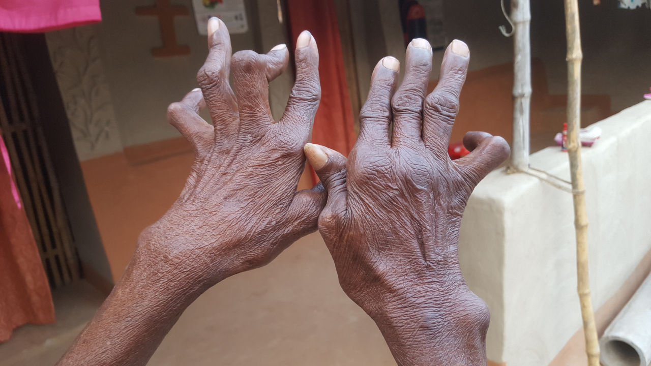 Rheumatoid Arthritis