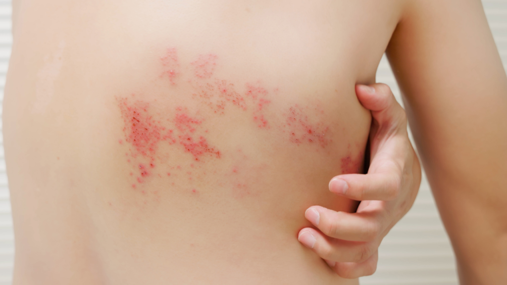 hingles: Symptoms, Causes, Treatment, Complications, and Prevention