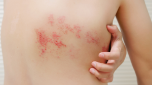hingles: Symptoms, Causes, Treatment, Complications, and Prevention