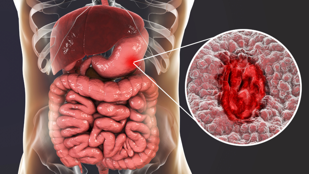 Ulcerative Colitis: Symptoms, Causes, Treatment, Diet, and Everyday Management