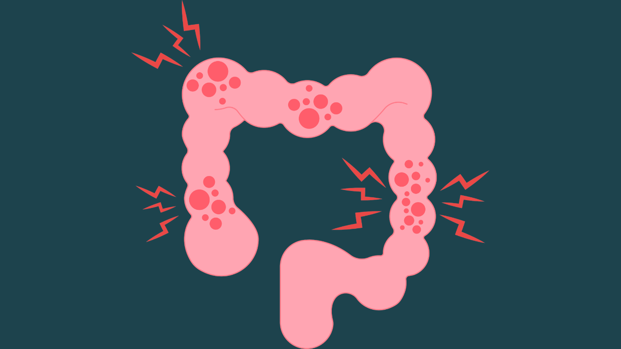 Crohn’s Disease Diet and Lifestyle Guide: Foods to Eat, Foods to Avoid, and Daily Management