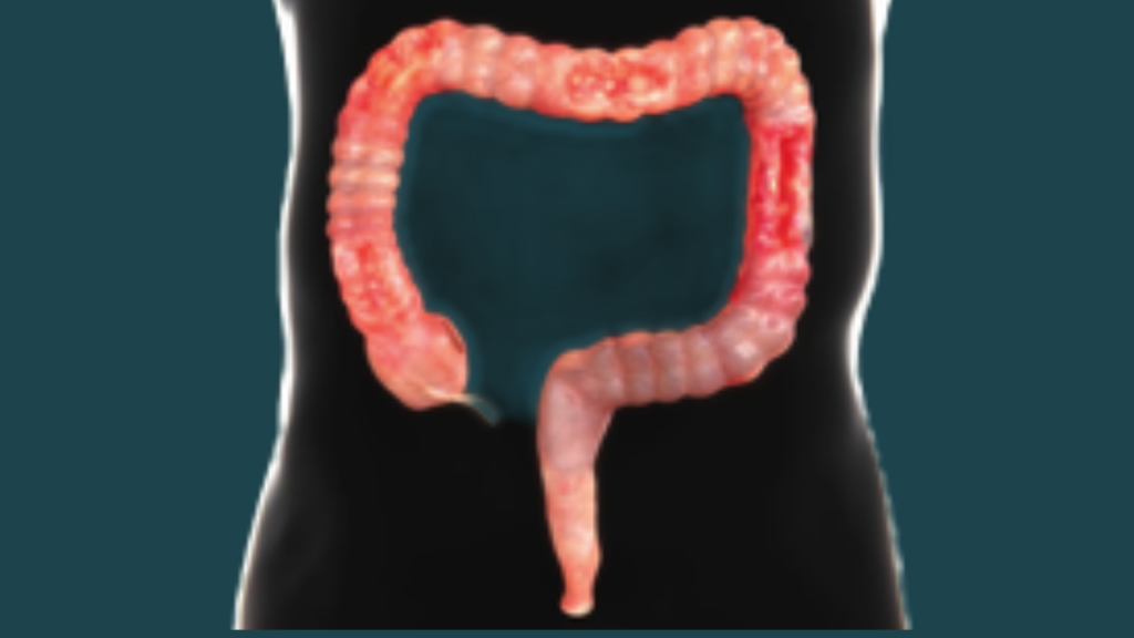 How Crohn’s Disease Is Diagnosed and Treated: Tests, Medications, and Surgery
