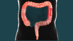Crohn’s Disease Explained (Part 2): Diagnosis, Treatment, Medications, Biologic Therapies, and Surgery