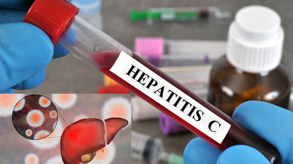 Hepatitis C: Symptoms, Causes, Testing, Treatment, and How to Protect Your Liver