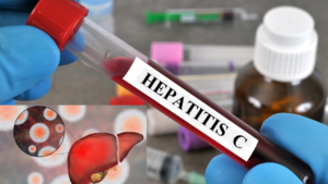 Hepatitis C: Symptoms, Causes, Testing, Treatment, and How to Protect Your Liver
